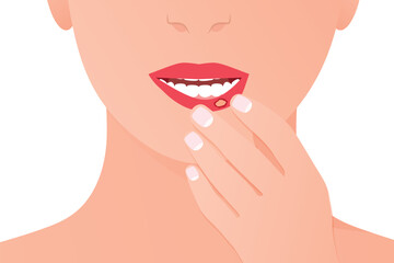 canker sore, aphthous on the lip; medical concept for oral health, inflammation, stomatitis and dermatology education- vector illustration