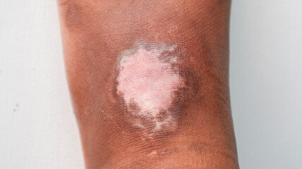 Legs with visible wound healing patches on top, highlighting the skin condition.