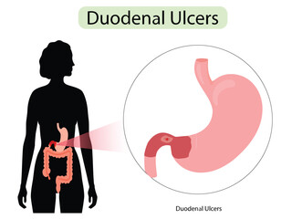 Duodenal Ulcers Peptic Ulcer Disease Medical Vector Illustration
