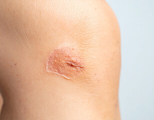 Fototapeta premium Close-up of a Human Knee with a Healing Wound and Scabbing