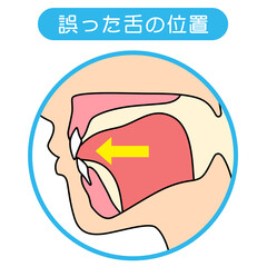 正しいミューイングの方法　適正な舌の位置と誤った舌の位置 © koti