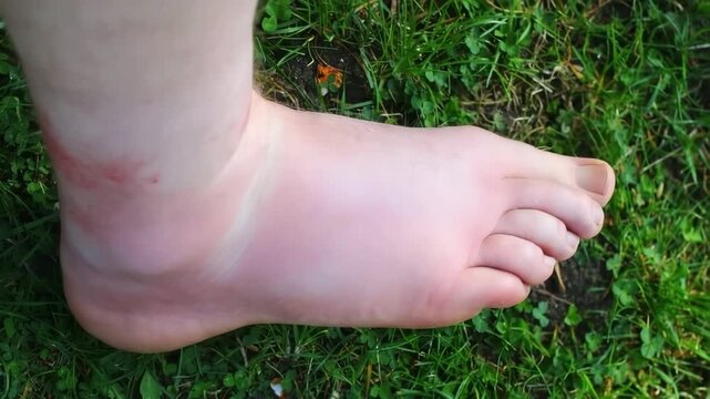 Swelling in leg after bee sting incident observed outdoors