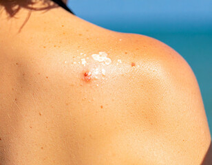Fototapeta premium Woman's Shoulder with Skin Condition and Sunscreen by the Ocean