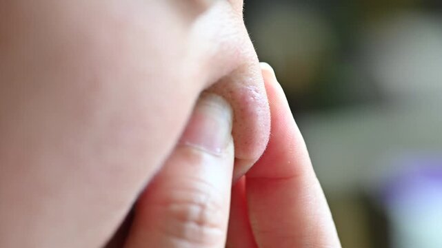 4K Close up of woman squeezing out black heads with her fingers