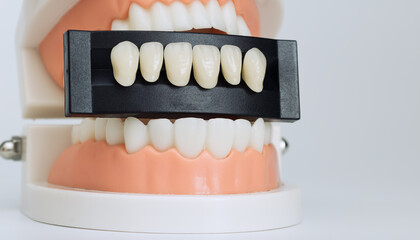 Dental model with veneer shade guide