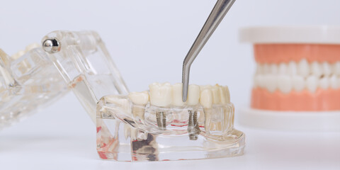 Placing dental crown on implant model