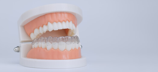 Clear dental aligner on tooth model