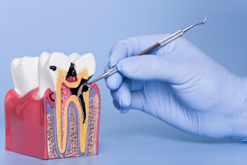 Dental model with severe tooth decay examination