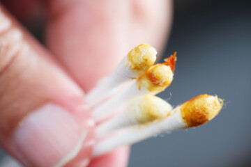Close up shot of wet brown ear wax on cotton bud