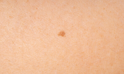 Skin mole spot closeup. Human birthmark, nevus macro texture