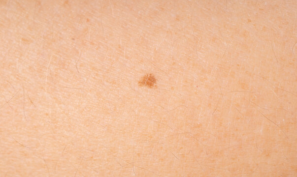 Skin mole spot closeup. Human birthmark, nevus macro texture