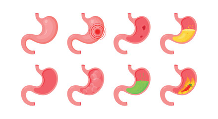 Human stomach. Healthy and unhealthy, empty and full human stomach. Bloating stomach ache, digestive tract pain fullness heaviness stomaches acid heartburn process indigestion © mi-vector