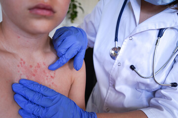 The physician is inspecting the child's skin for signs of varicella or monkeypox.