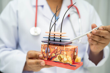 Hair transplant, Asian dermatologist doctor holding skin structure anatomy model for treatment in...