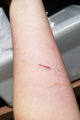 Cut on the arm with blood.