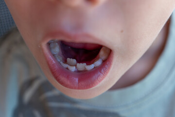 Close up of a child's open mouth revealing ectopic eruption (two row teeth) and missing milk teeth,...