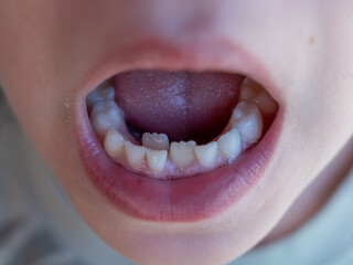 Child's mouth revealing transitioning dentition, two row teeth or ectopic eruption, with permanent...