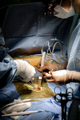 Close up two cardiac surgeons do femoral cannulation for cardiac operation in operating room in...