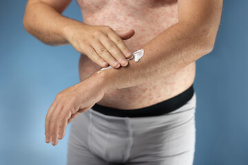 A body covered with a red rash being gently creamed. A hand is applying a thin layer of soothing...