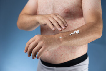 Obraz premium A body covered with a red rash being gently creamed. A hand is applying a thin layer of soothing cream over the irritated skin, emphasizing care and relief efforts for the rash