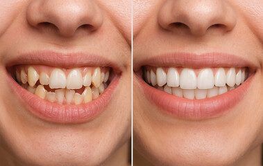 Close up of female smile showing before and after dental treatment with straight white teeth. Concept of cosmetic dentistry, smile makeover, teeth whitening, orthodontic improvement, comparison
