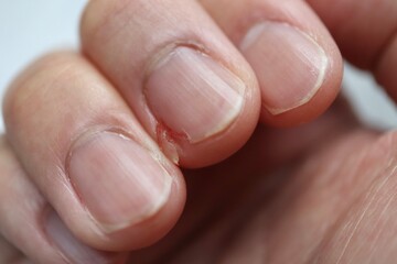 怪我で割れた中指の爪。軽い出血のクローズアップ。