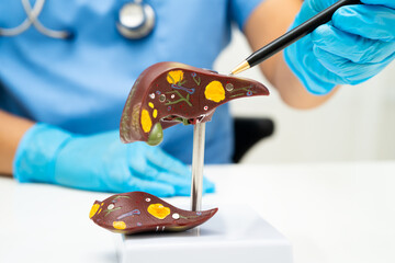 Cirrhosis, Liver cancer, fatty liver, Asian doctor with liver human anatomy model in World Hepatitis Day at hospital.