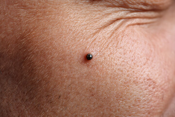 Fototapeta premium Close-up of a raised mole on caucasian skin
