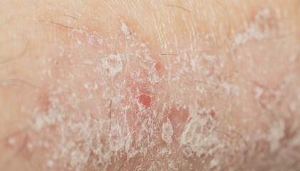Close-up of dry, flaky and red human skin, showing symptoms of psoriasis, eczema or dermatitis.