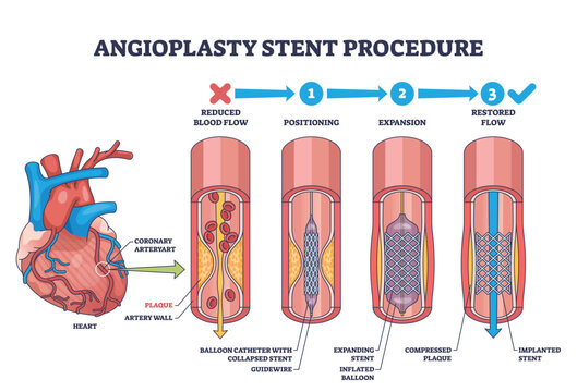 Angioplasty stent procedure shows heart, artery, and stent placement to restore blood flow. Outline diagram