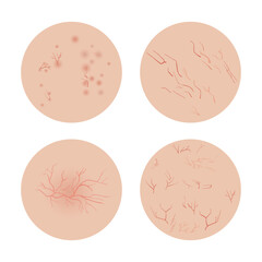 Four Types of Rosacea Showing Different Symptoms on Skin