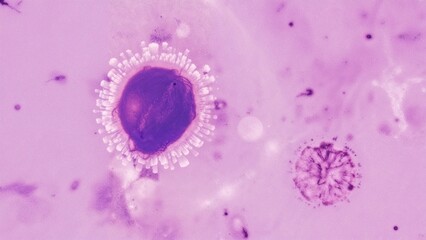 Photomicrograph of a blood smear displaying lymphoblasts in acute lymphoblastic leukemia