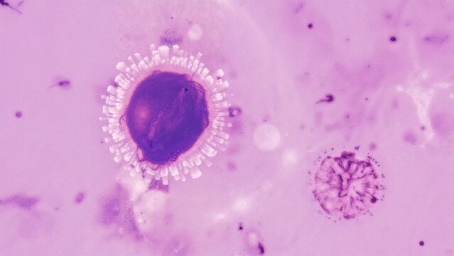 Photomicrograph of a blood smear displaying lymphoblasts in acute lymphoblastic leukemia