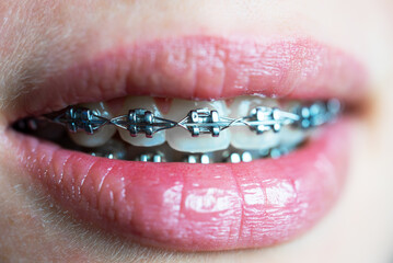 Close up of teenage girl's mouth with braces.