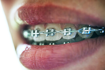 Close up of teenage girl's mouth with braces.