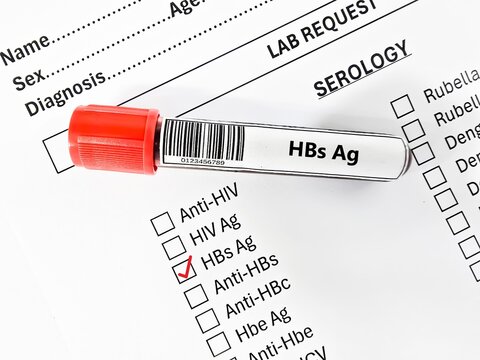 Blood sample tube and paper order request for HBs Ag test analysis.