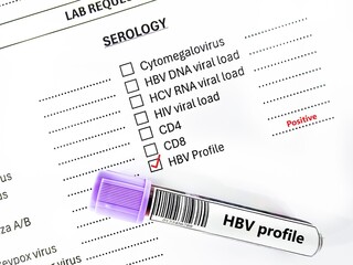 Blood sample tube positive result for HBV profile test analysis.