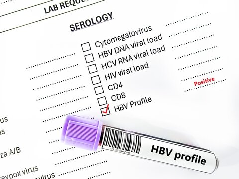 Blood sample tube positive result for HBV profile test analysis. - Powered by Adobe