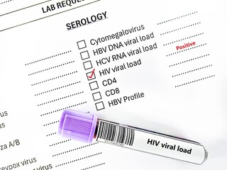 Blood sample tube positive result for HIV viral load test analysis.