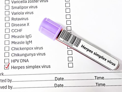 Blood sample tube and paper order request for herpes simplex virus test analysis.