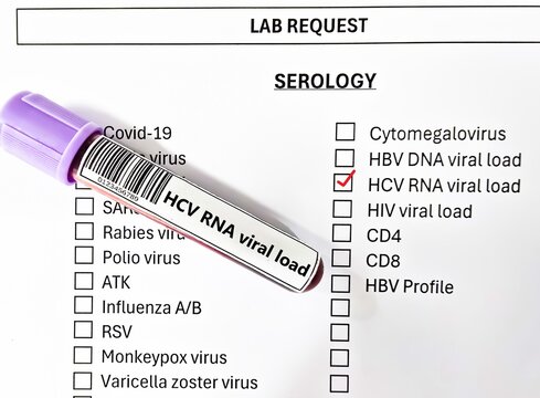 Blood sample tube and paper order request for HCV RNA viral load test analysis.
