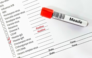 Blood sample tube positive result for measle virus.