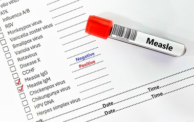 Blood sample tube positive result for measle IgM and negative for measle IgG test analysis.