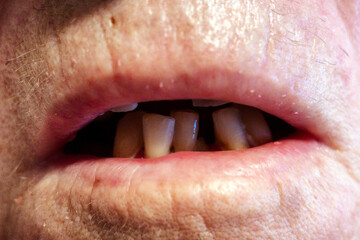 Rottem teeth in a old person