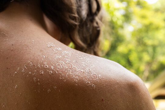 Sunburned Shoulders After a Day in the Tropical Sun