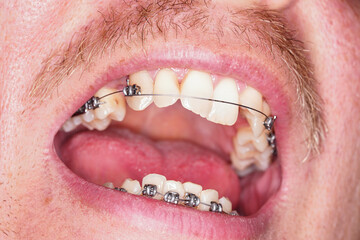 Man with dental braces, upper wire is damaged and loose, closeup detail to open mouth
