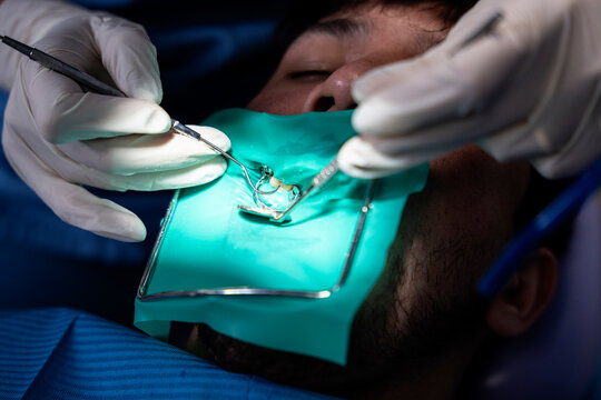 Dentist performing root canal therapy using specialized tools