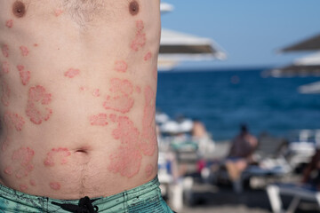 Individual With Psoriasis Resting on a Beach Enjoying the Summer Sun, With Visible Skin Condition...