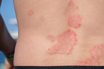 Psoriasis Flare-Up on the Back of a Person During a Sunny Day Outdoors