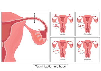 Tubal ligation is surgery to close a woman's fallopian tubes.